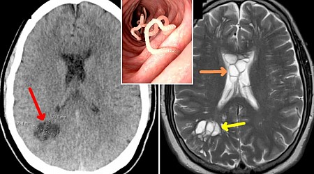 Florida man complains of migraines — docs find tapeworm in his brain from eating undercooked bacon