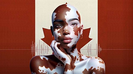 Kingstonian founder of Vitiligo Voices Canada shares insights ahead of World Vitiligo Day