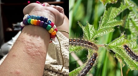I woke up covered in a painful rash. A caterpillar with toxic hairs was to blame.
