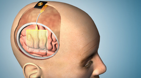 This new brain-mapping device could make neurosurgery safer