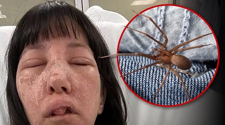 Georgia Woman Suffers Horrible Injuries After Attack from Deadly Spiders