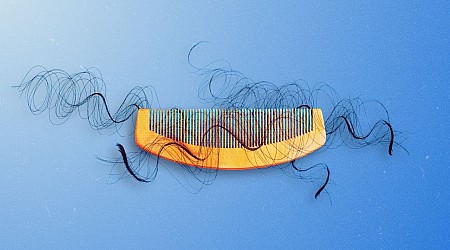 How Much Hair Loss Is Normal for Women?