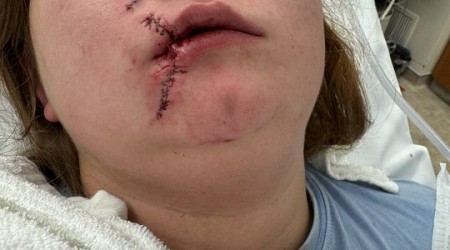 College student receives 100 stitches after pitbull attack