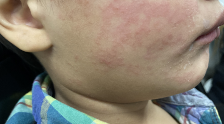 Record measles outbreak in Oregon blamed on vaccine exemptions