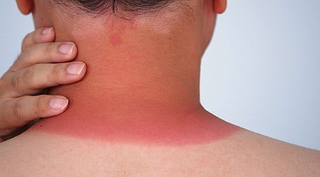 Why the Sunburns-for-Acne TikTok Trend Is So Stupid