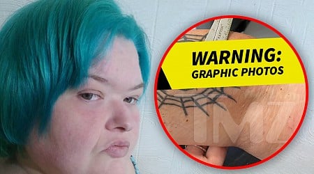 First Look at '1000-Lb. Sisters' Star Amy Slaton's Wound From 'Camel Bite'