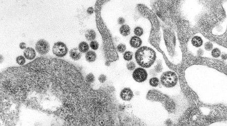 Iowa resident dies of rare Lassa fever, officials say