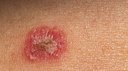 A Sexually Transmitted Ringworm Fungus Is Spreading in New York City