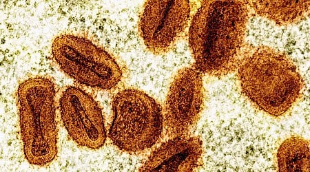 US Health officials report first known case of new, more severe strain of monkeypox