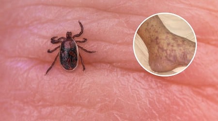 Tick Bite Disease in California Leaves Three Dead