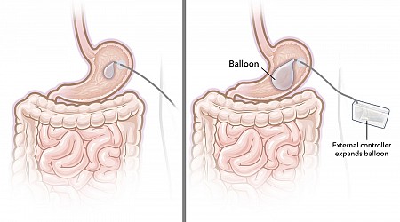 Ozempic Not Working for You? A Stomach Balloon Is the Latest Hope for W