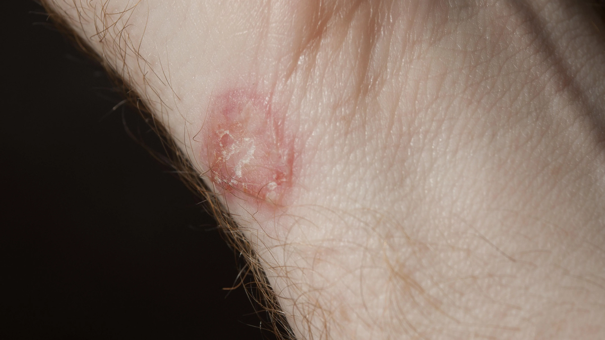 New Ringworm Fungi Are Spreading Sexually and Becoming Harder to Kill