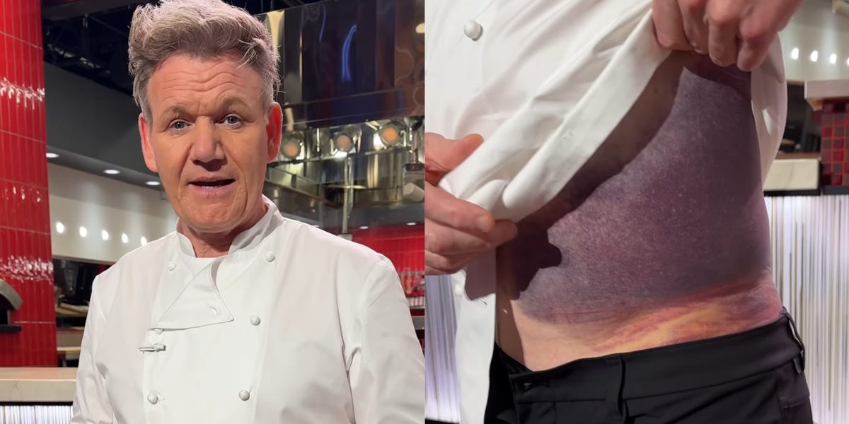 Gordon Ramsay shows off a scary bruise on his torso after getting in a 'really bad' bike accident: 'I'm lucky to be alive'