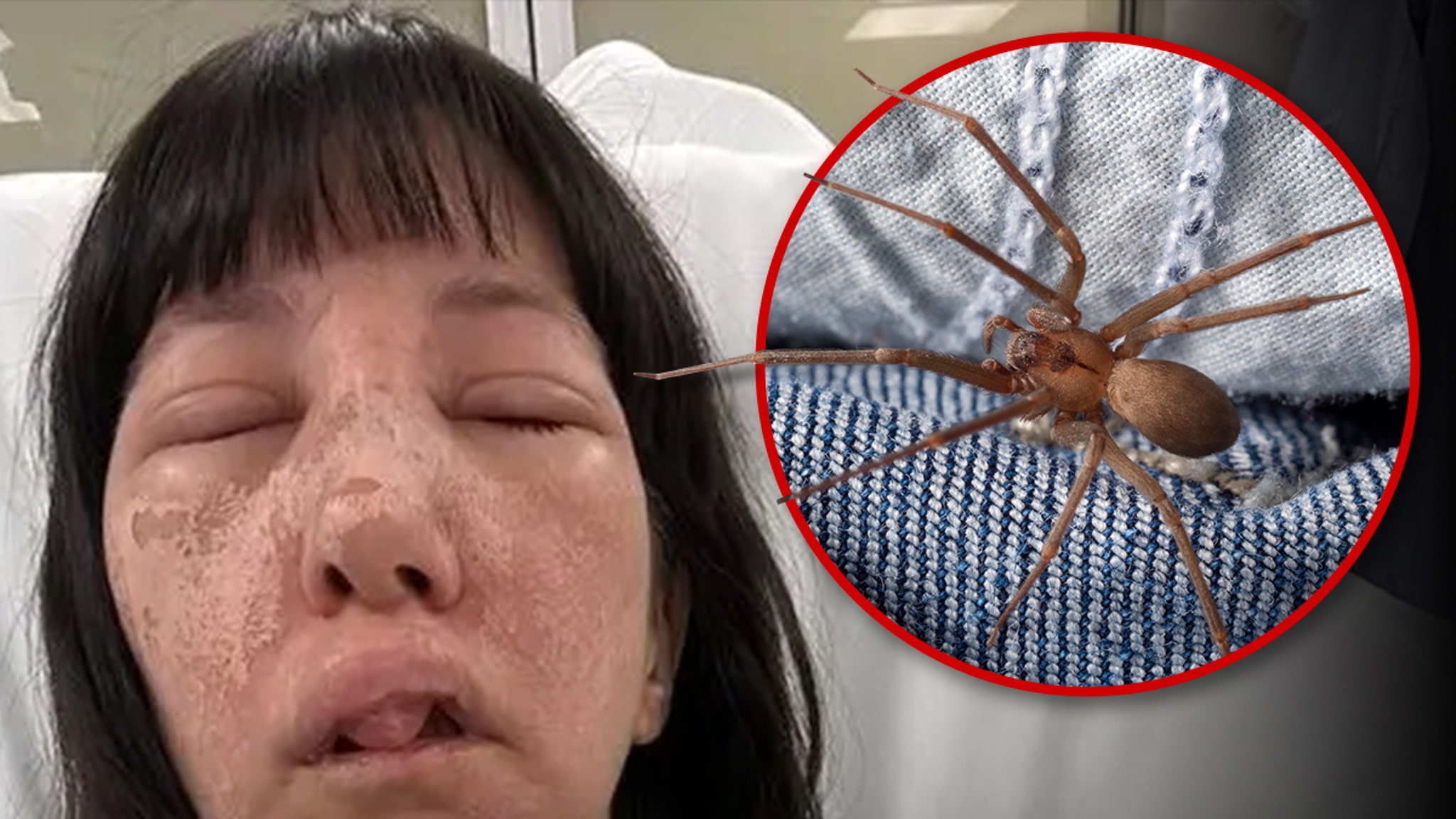 Georgia Woman Suffers Horrible Injuries After Attack from Deadly Spiders