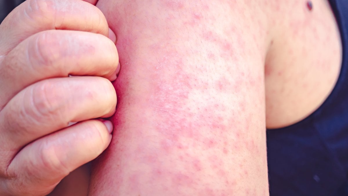 Person who traveled abroad is 1st Mass. measles case since 2020