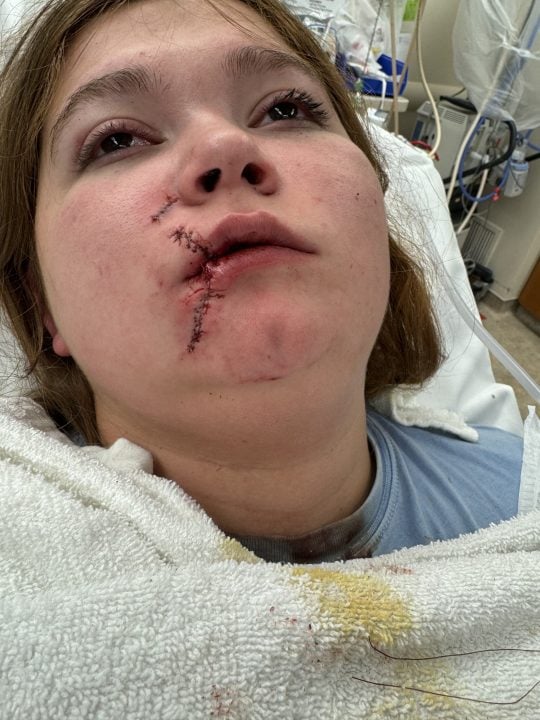 College student receives 100 stitches after pitbull attack