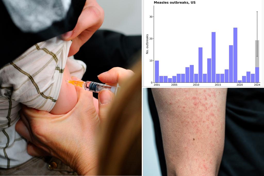 Measles cases in US triple last year’s total