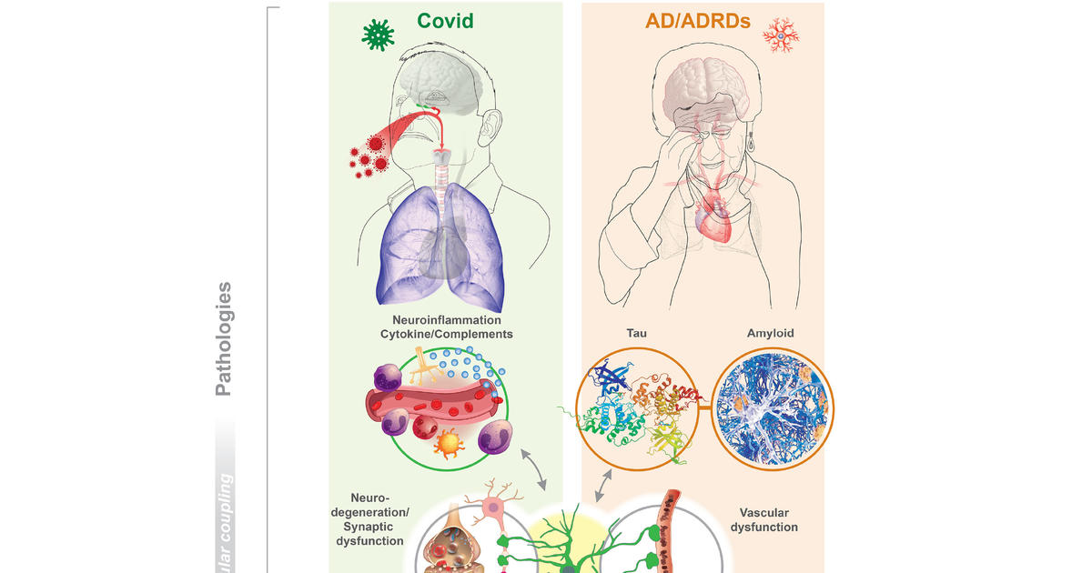 UK researchers find Alzheimer's-like brain changes in long Covid patients