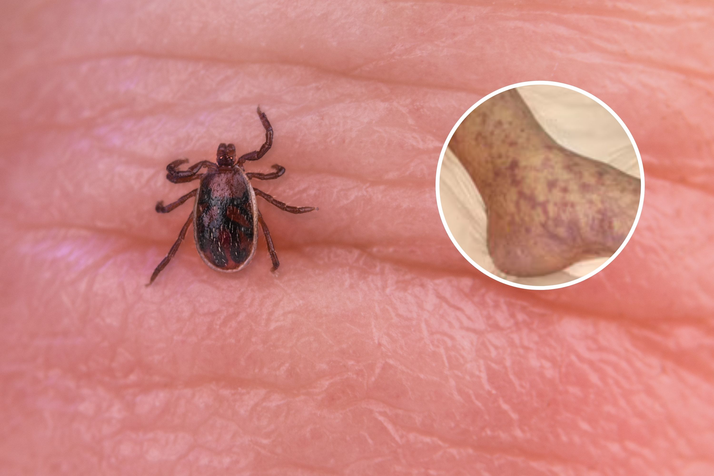 Tick Bite Disease in California Leaves Three Dead