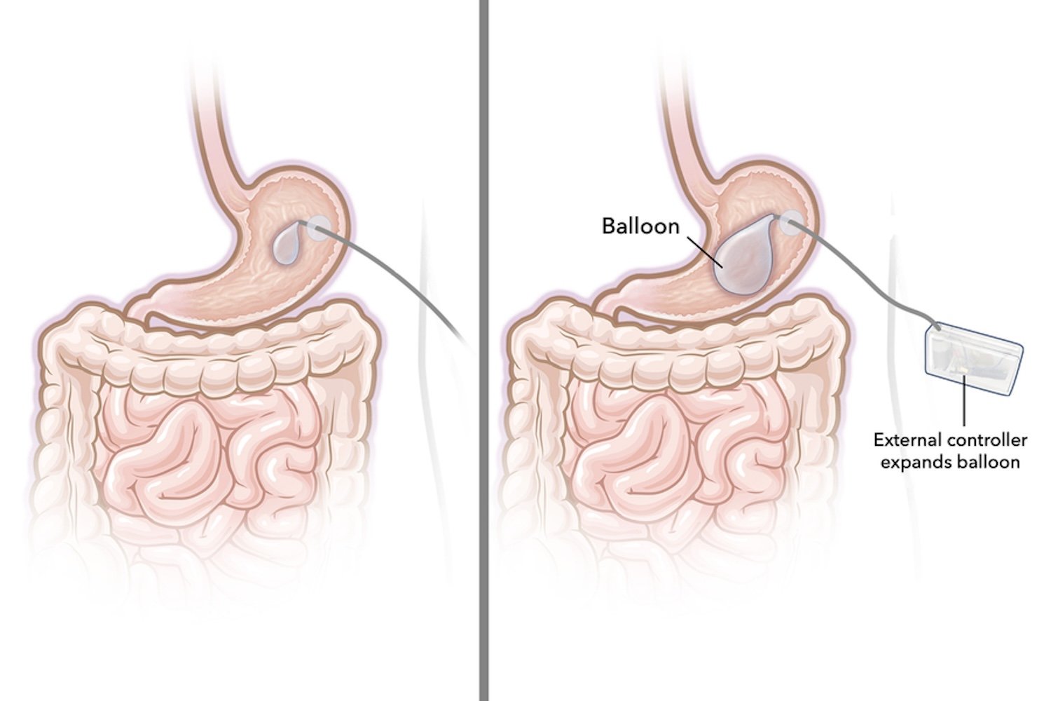 Ozempic Not Working for You? A Stomach Balloon Is the Latest Hope for W